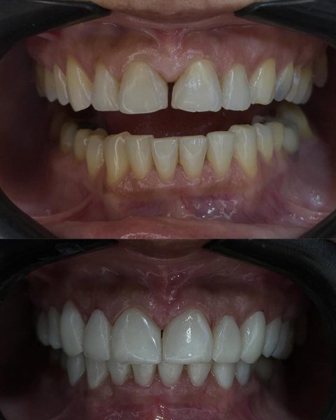 Antes e depois de lentes dentais — Um sorriso de dar inveja