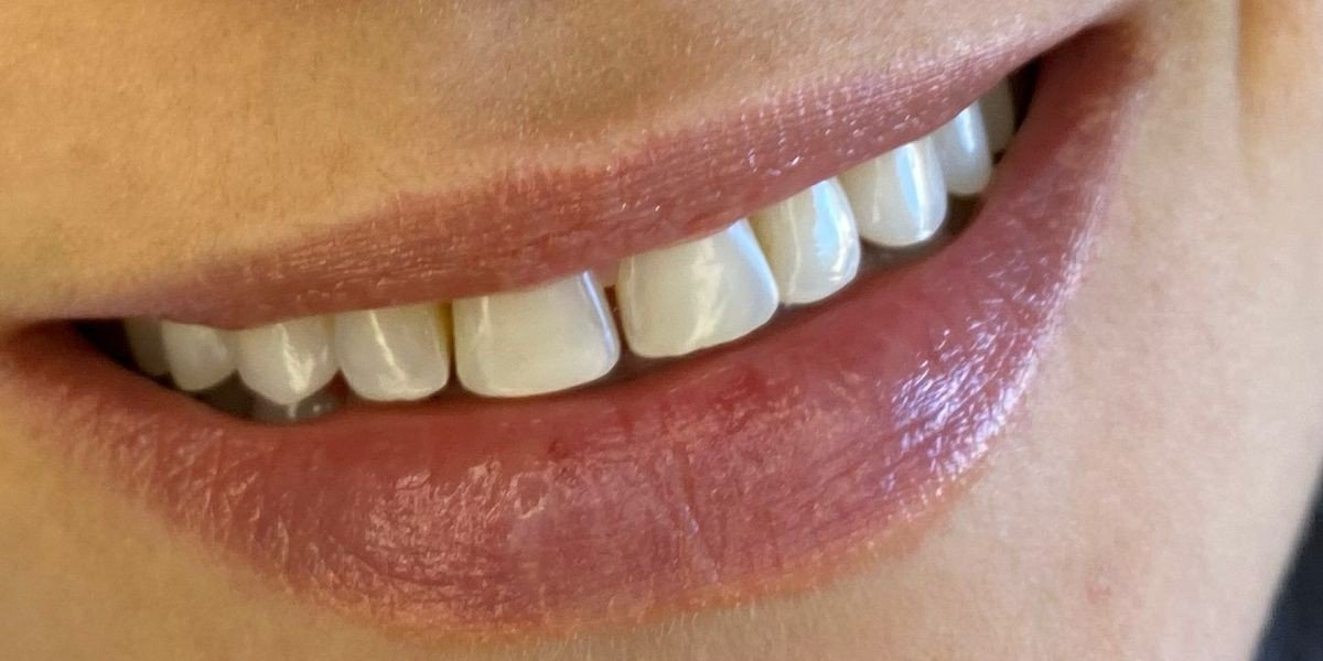Antes das lentes dentais — caso 2